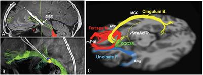 The Use of Tractography-Based Targeting in Deep Brain Stimulation for Psychiatric Indications